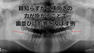 親知らずと歯列矯正の関係｜抜歯のメリット・デメリットを医師が徹底解説